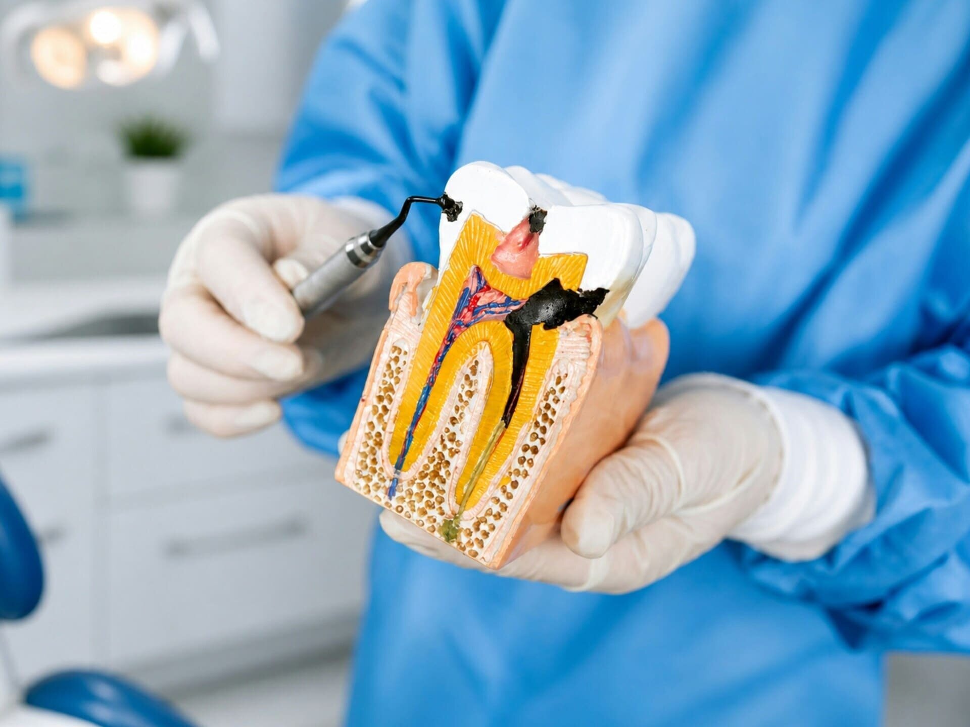 Model zęba z ubytkiem i narzędziem stomatologicznym w rękach lekarza